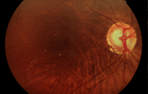 Glaucoma leads to vision loss by gradually damaging the optic nerve