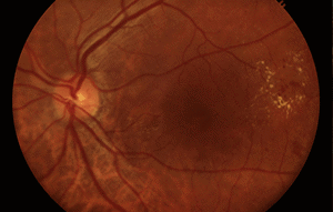 Diabetic retinopathy is onset by diabetes and causes damage to the retina